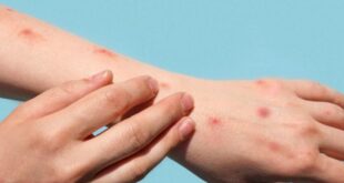 Mpox latest in Spain: Health chiefs call emergency meeting as number of cases per region is revealed