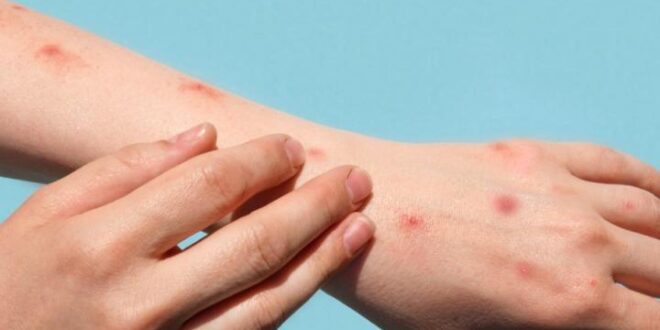 Mpox latest in Spain: Health chiefs call emergency meeting as number of cases per region is revealed