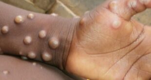 Monkeypox