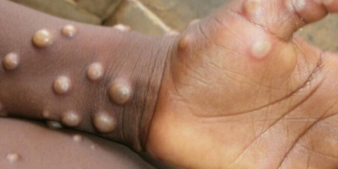 Monkeypox