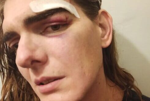 ‘I’m so scared’: Trans woman suffers horrific attack on the streets of Madrid