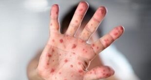 Measles warning on the Costa del Sol: Outbreak is declared at a school in Mijas - CSN News