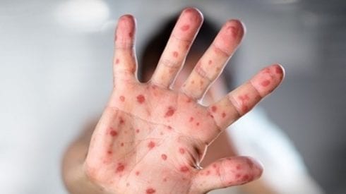 Measles warning on the Costa del Sol: Outbreak is declared at a school in Mijas - CSN News