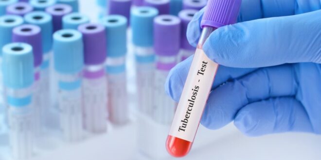 WHO sounds alarm on global tuberculosis crisis - CSN News