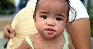 Measles alert continues in the Costa del Sol – including in these tourist hotspots 