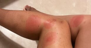 What you need to know about Skeeter syndrome – before summer starts