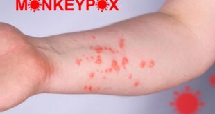 New Mpox case confirmed in Zaragoza, marking 198 Spanish cases in 2025