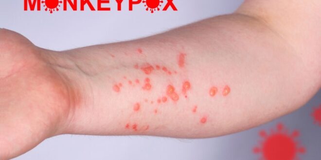 New Mpox case confirmed in Zaragoza, marking 198 Spanish cases in 2025