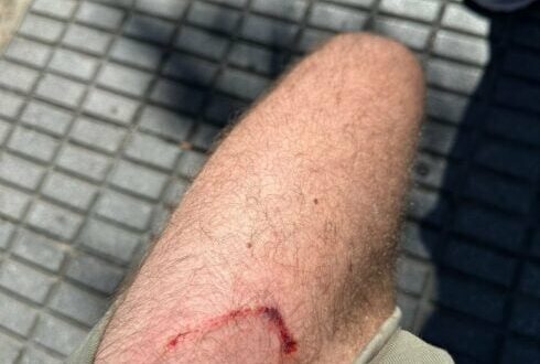 EXCLUSIVE: ‘I was mauled by an out-of-control police dog on holiday in Spain – imagine if I had been a young child’