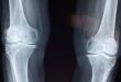 Major arthritis breakthrough: Stanford scientists REGROW cartilage