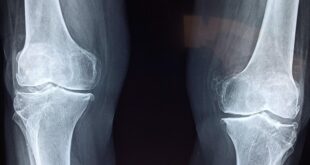 Major arthritis breakthrough: Stanford scientists REGROW cartilage