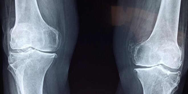 Major arthritis breakthrough: Stanford scientists REGROW cartilage