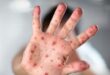 Urgent health warning in Madrid after dozens infected in measles outbreak: Here’s how to stay safe against the disease