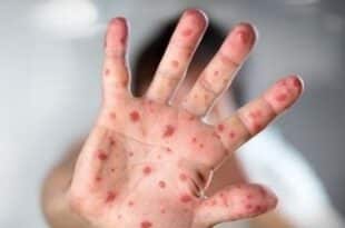Urgent health warning in Madrid after dozens infected in measles outbreak: Here’s how to stay safe against the disease