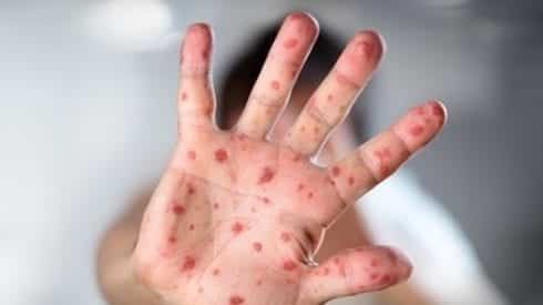 Urgent health warning in Madrid after dozens infected in measles outbreak: Here’s how to stay safe against the disease