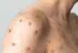 Monkeypox case confirmed at Marbella hospital as patient is admitted – health authorities urge calm