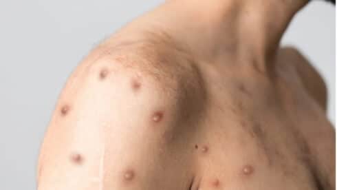 Monkeypox case confirmed at Marbella hospital as patient is admitted – health authorities urge calm